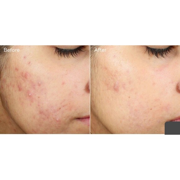Murad InvisiScar Resurfacing Treatment FULL SIZE - Picture 8 of 12